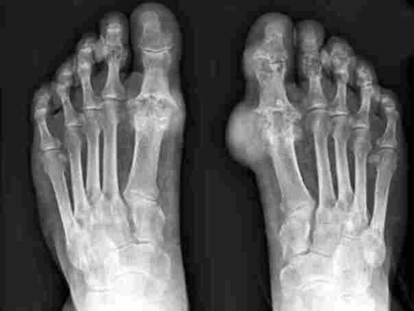 গেঁটেবাত ও অ্যালোপিউরিনল: হঠাৎ তীব্র যন্ত্রণা ও প্রতিরোধের উপায়